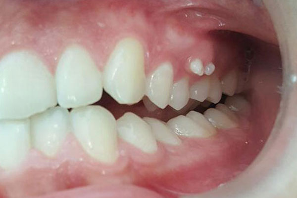 Dentes-supranumerários